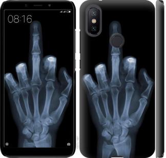 Чехол на Xiaomi Mi A2 Рука через рентген