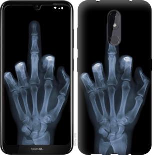 Чехол на Nokia 3.2 Рука через рентген