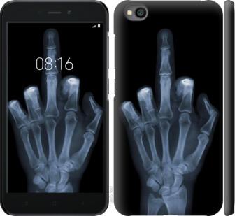 Чехол на Xiaomi Redmi Go Рука через рентген